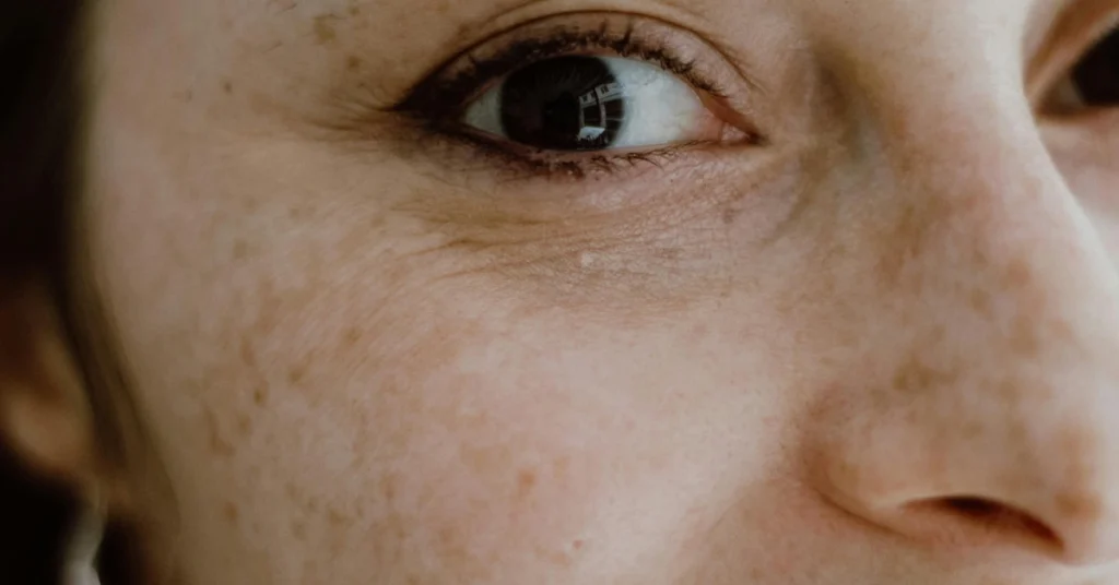 Dark spots